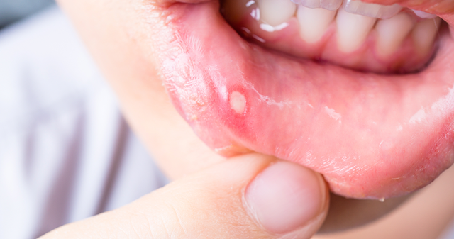 Blister